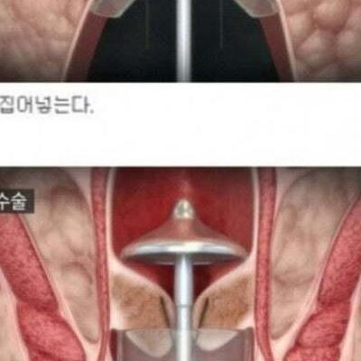 똥꼬가 짜릿해지는 수술 과정.jpg